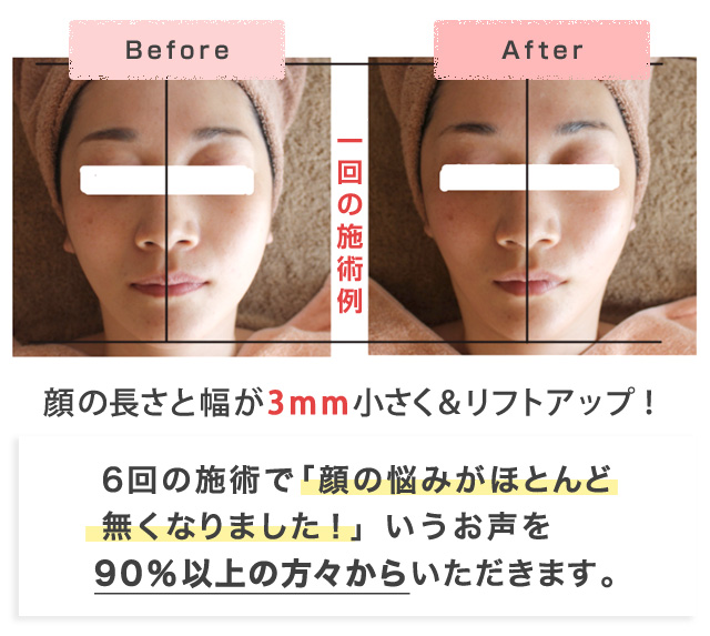 1回の施術でも顔の変化がわかる