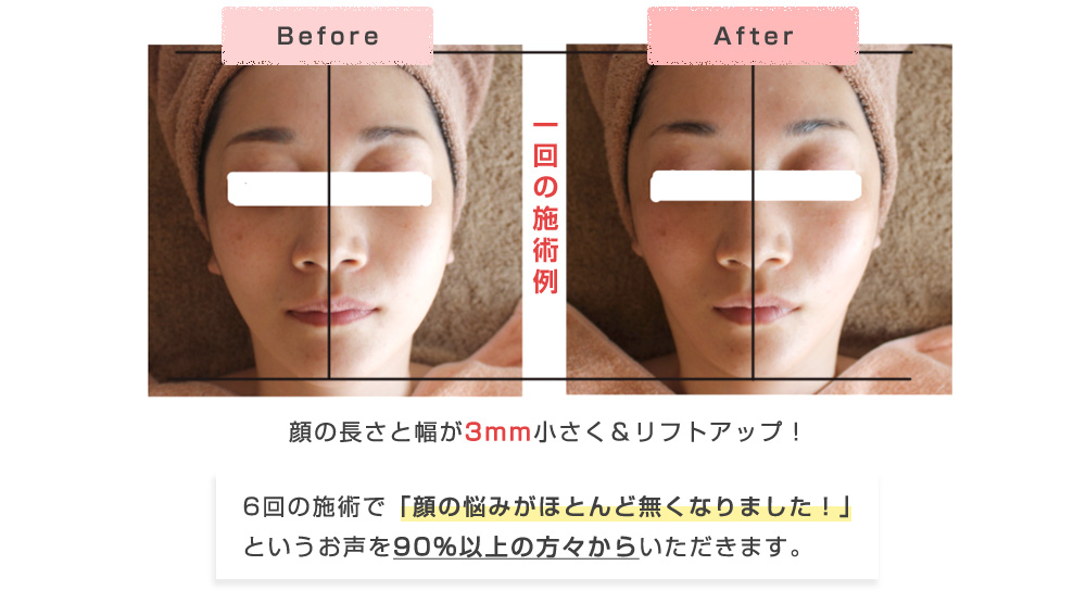 1回の施術でも顔の変化がわかる