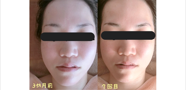 顔が小さくなり、鼻も少し高くなりました。